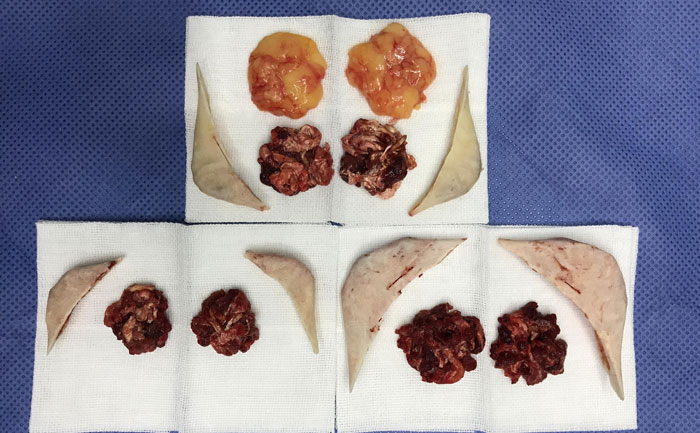 磨骨瘦臉費(fèi)用多少錢？