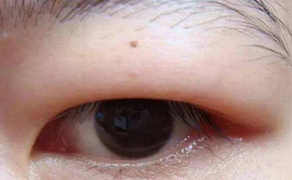 如何區(qū)分腫泡眼和眼球突出?術(shù)前檢查過程?