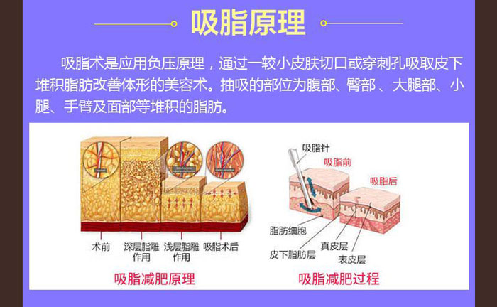 水動(dòng)力吸脂效果好嗎？