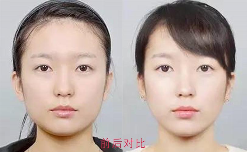 面部吸脂前后效果對比