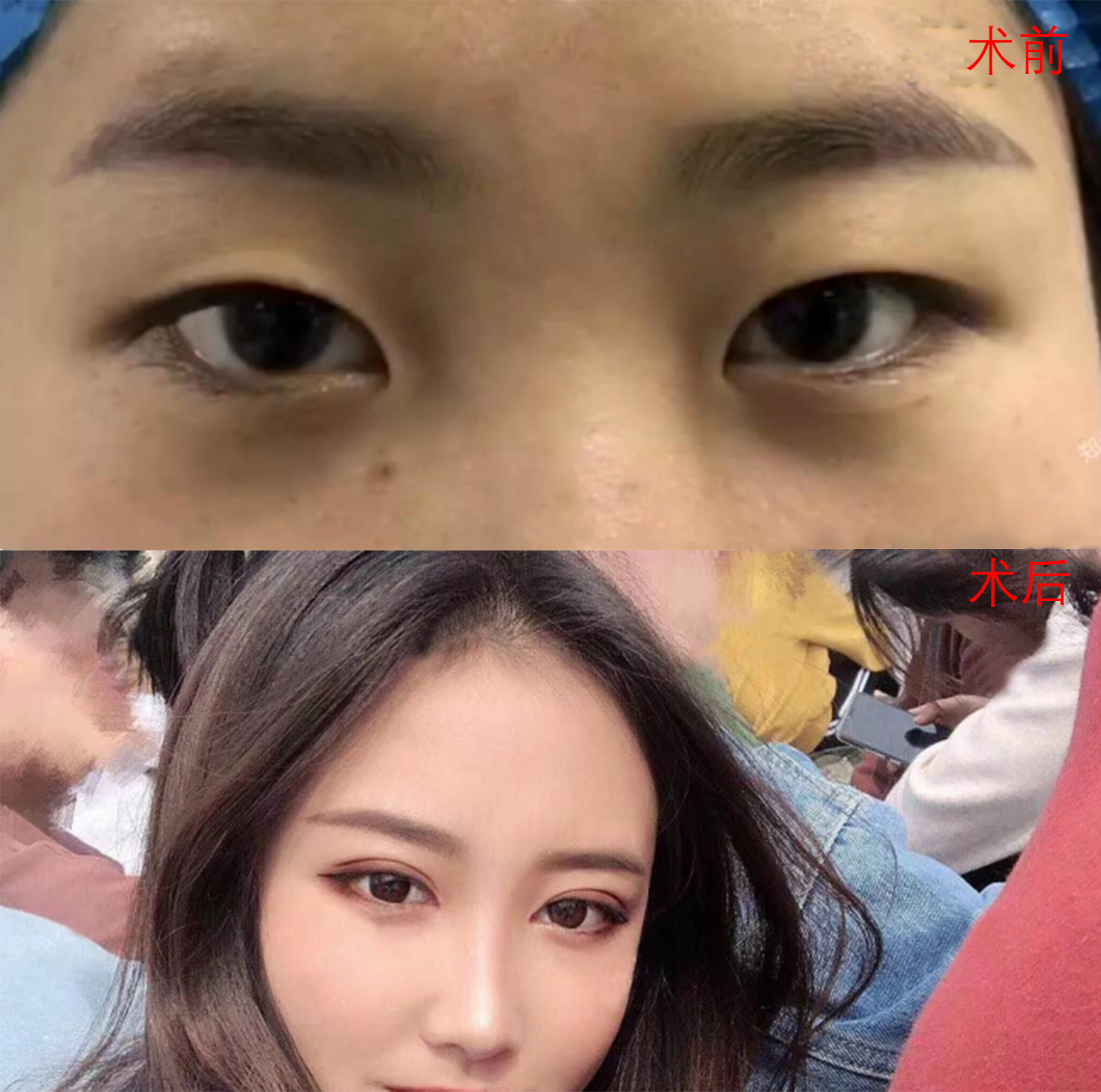 西安壹加壹李建輝醫(yī)生雙眼皮整形案例