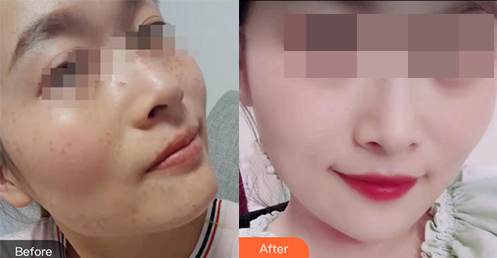 南寧東方整形祛斑案例效果對比1