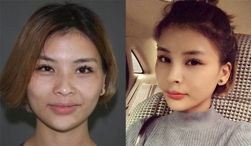 北京禾美嘉面部填充打造精致少女臉