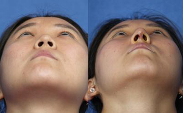 隆鼻手術(shù)失敗的表現(xiàn)有哪些?術(shù)后護(hù)理有哪些?