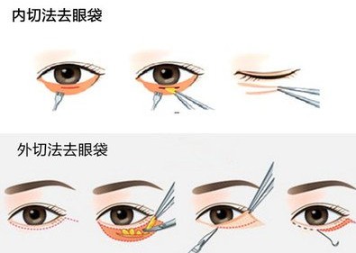 內(nèi)切法祛眼袋
