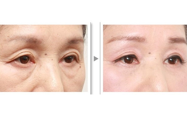 上瞼松弛是什么原因?怎么辦?