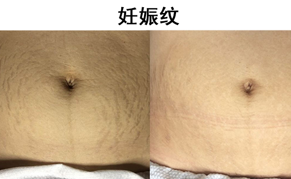 肥胖紋和妊娠紋有什么區(qū)別?有共同點嗎?