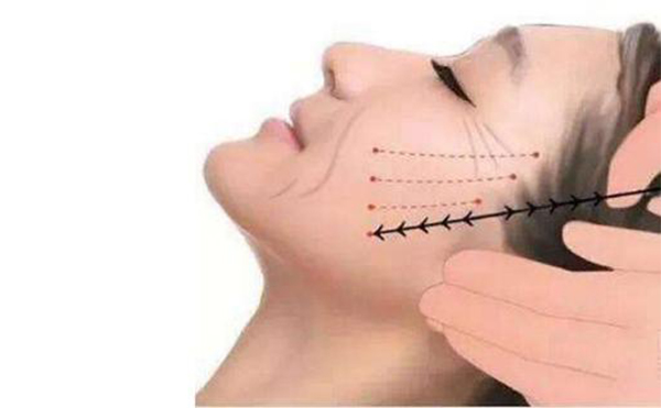 線雕提升適合哪些人做？