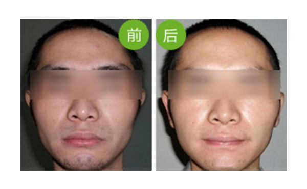 冰點(diǎn)面部脫毛值得做嗎？