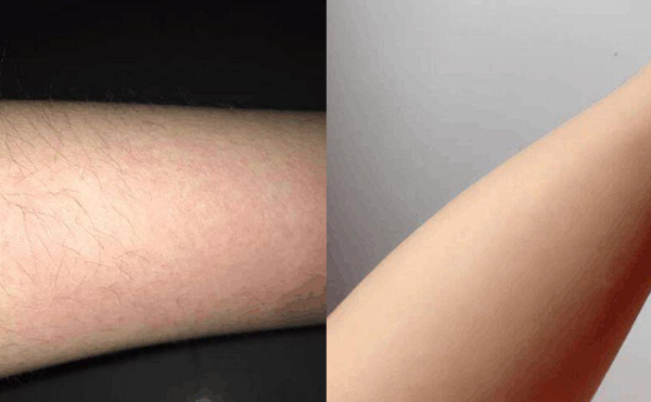 激光手臂脫毛安全嗎？