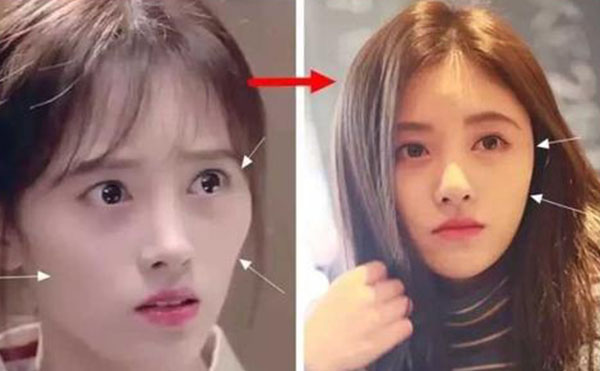 顴骨內(nèi)推術(shù)后護(hù)理工作