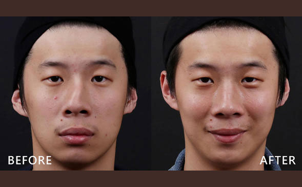 鼻骨矯正手術(shù)多少錢？鼻骨矯正手術(shù)危險(xiǎn)嗎？