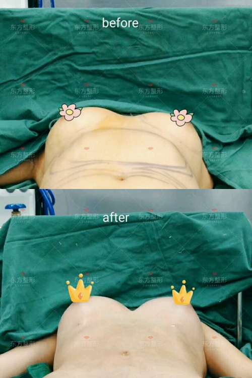 廣西南寧東方整形術(shù)后即刻效果
