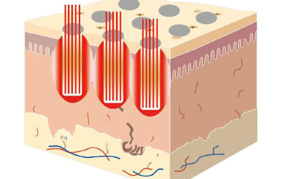 點陣激光祛斑后多久消失？