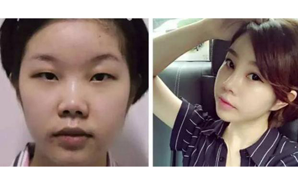 鼻頭縮小手術是怎么做的?效果怎么樣?