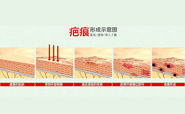 疤痕體質割雙眼皮怎么樣?如何自測疤痕體質?