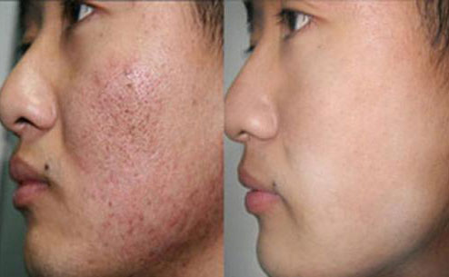痘坑修復(fù)激光手術(shù)大概要多少錢？