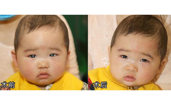 年齡小做眼瞼缺損矯正效果如何?術(shù)前術(shù)后有什么注意事項?