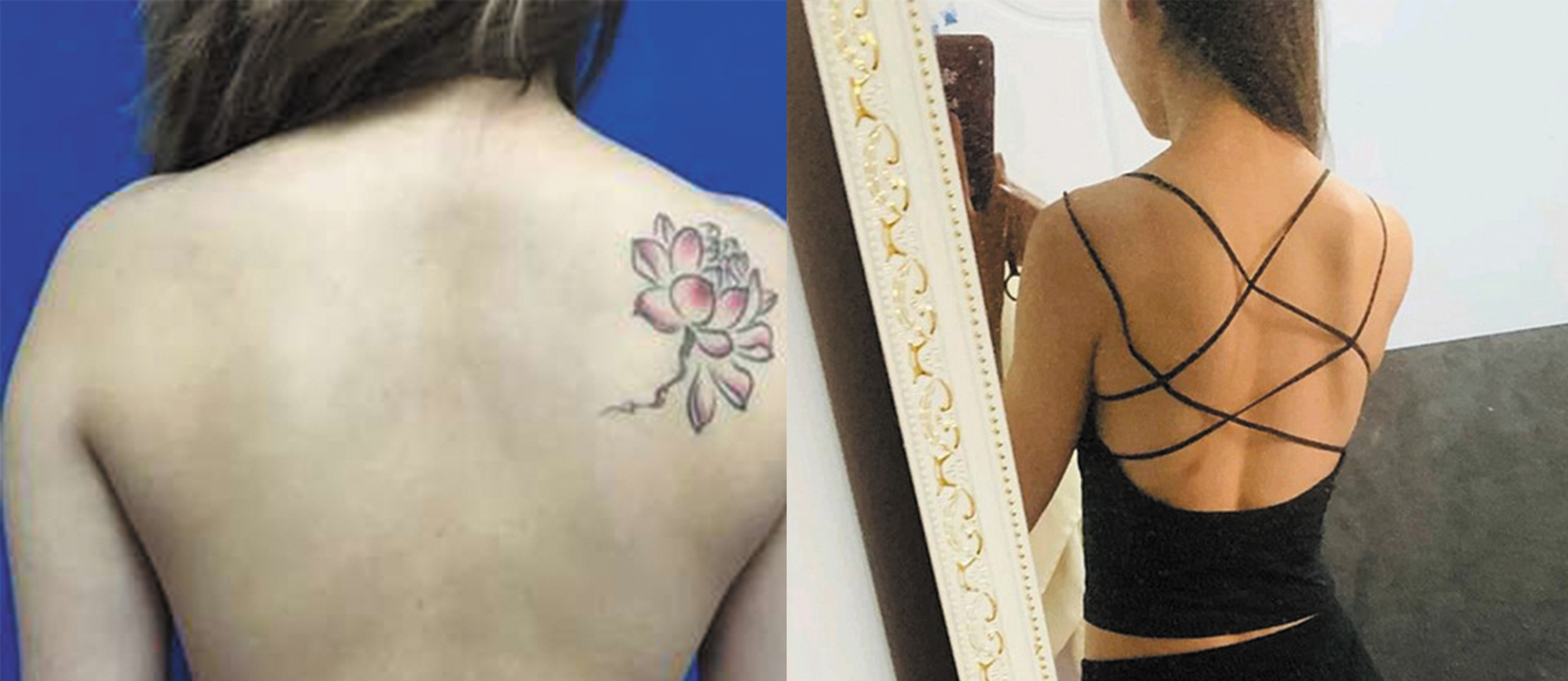 背部吸脂手術(shù)對比圖2