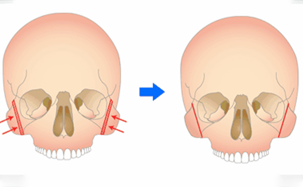 顴骨整形手術(shù)安不安全？有危險嗎？