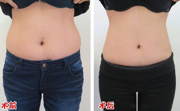 腹部吸脂效果如何？