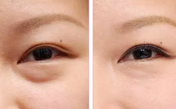 內(nèi)切去眼袋安全性怎么樣?內(nèi)切去眼袋會(huì)復(fù)發(fā)嗎?