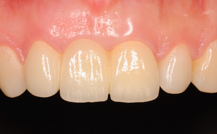 門牙種植牙需要多少錢一顆？