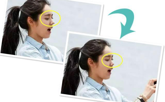 朝天鼻手術(shù)需要多少錢？