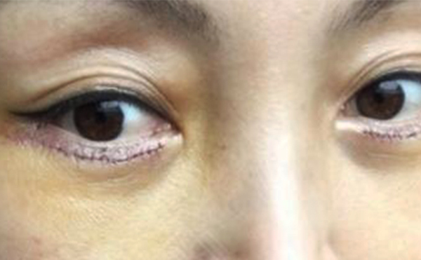 眼袋修復一般多少錢?眼袋修復術(shù)后怎么護理?