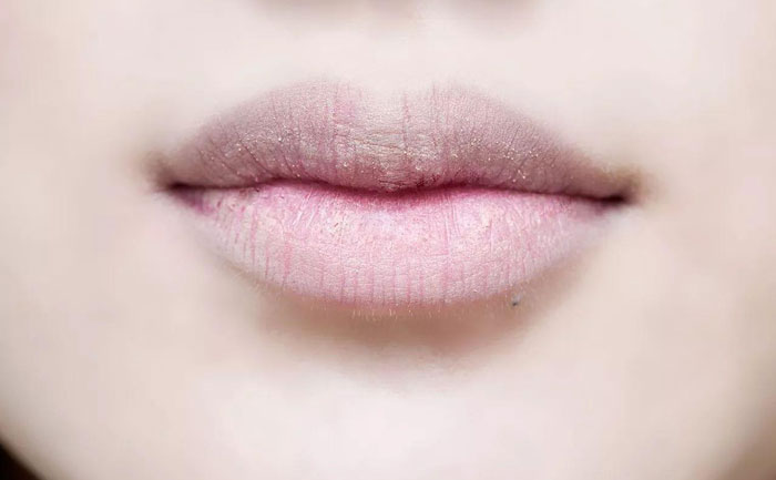 厚唇改薄多久完全恢復(fù)？