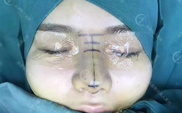 隆鼻術后多久能看到效果？