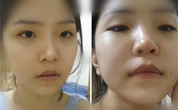 鼻翼缺損修復(fù)后和常人一樣嗎？