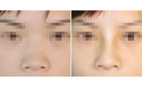 做隆鼻手術(shù)會留疤嗎？