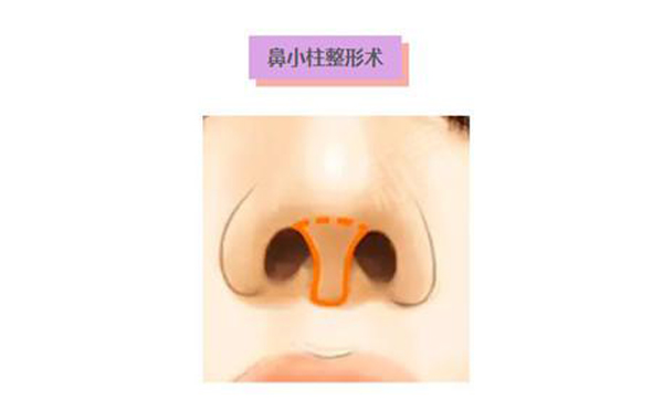 鼻小柱延長(zhǎng)術(shù)是什么？鼻小柱延長(zhǎng)手術(shù)有什么優(yōu)點(diǎn)