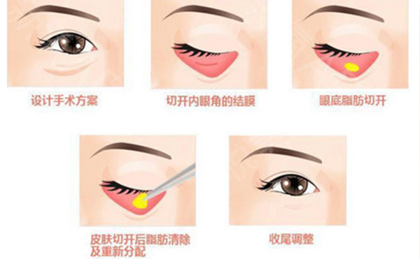 做去眼袋的手術(shù)會不會反彈?有副作用嗎?