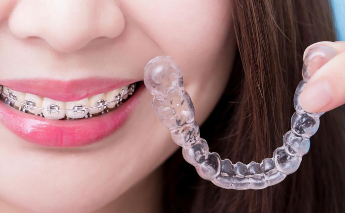 隱形牙套價格多少錢？