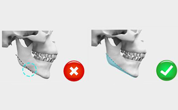 下頜角切除手術(shù)一般需要多少錢?