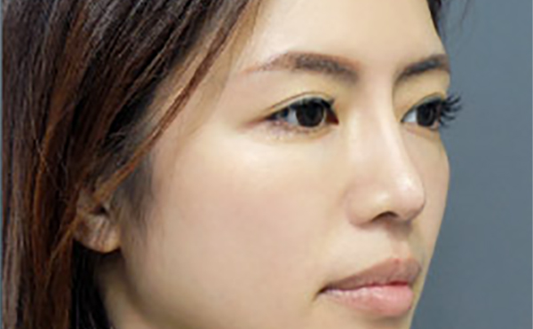 嘉興藝星整形：隆鼻失敗九大表現(xiàn)，快看看你有沒有