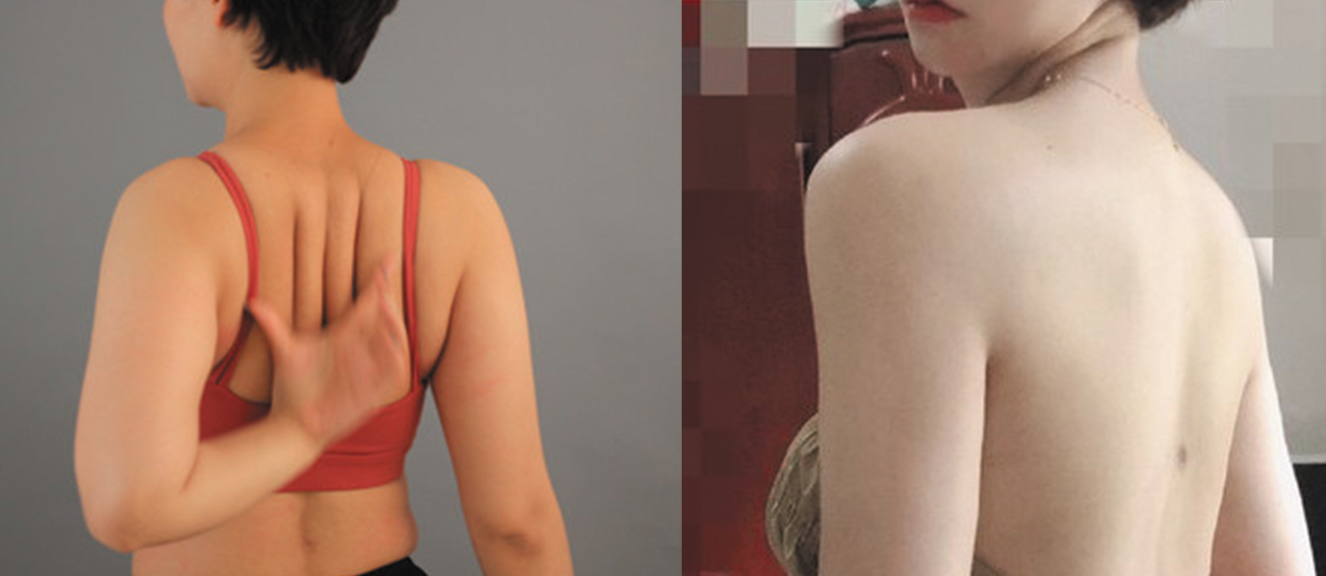 背部吸脂手術(shù)對比圖1