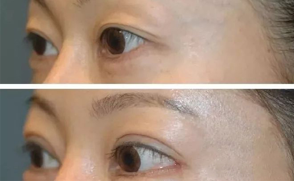 開外眼角需要多久恢復(fù)？