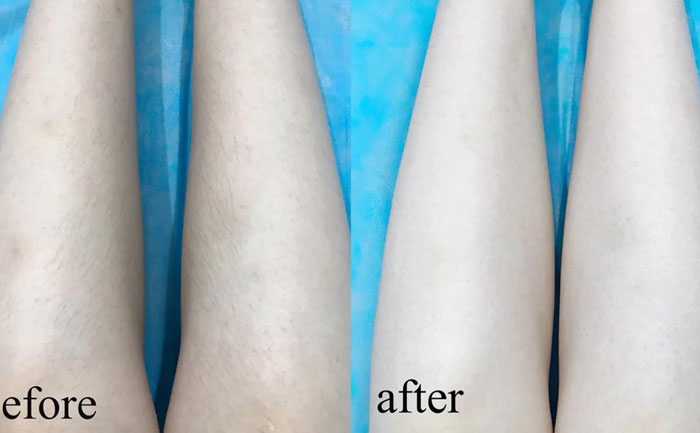 激光脫毛能永久脫毛嗎？