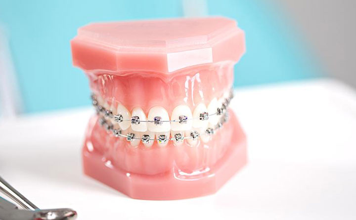 牙齒正畸費(fèi)用一般多少？