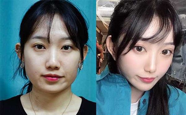 一般做下頜角整容風(fēng)險(xiǎn)有哪些?可以避免嗎?