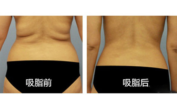 腹部吸脂需要多久恢復(fù)？