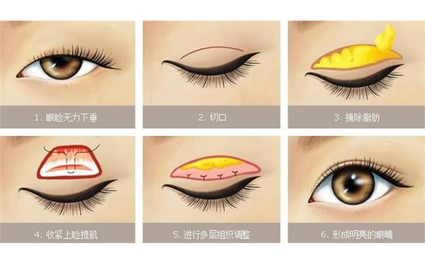 上瞼下垂價格多少?上瞼下垂術后有哪些問題?