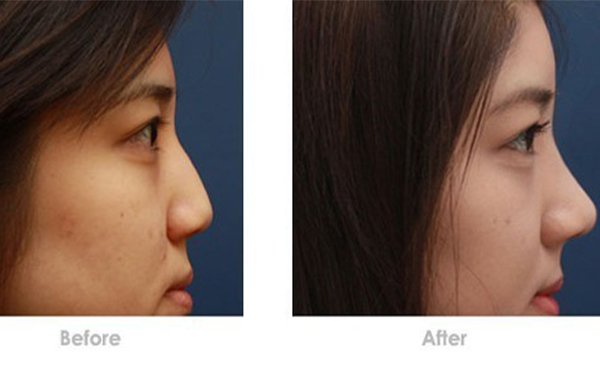 假體隆鼻取出來鼻子會變形嗎?