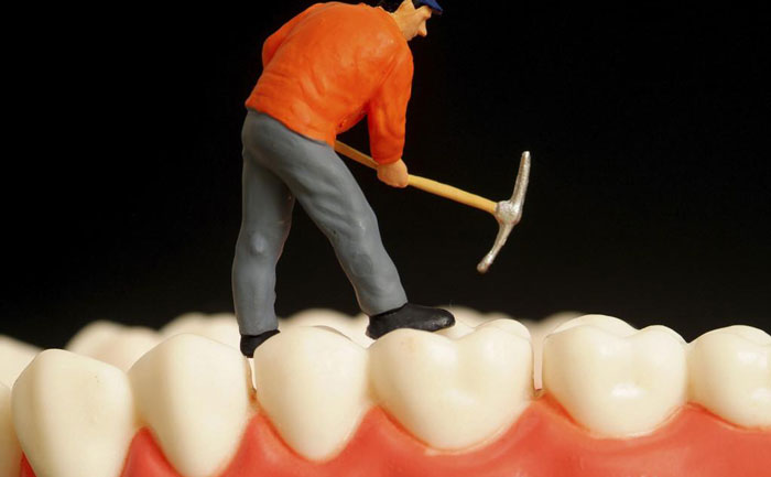 鑲牙要多少錢一顆費(fèi)用？