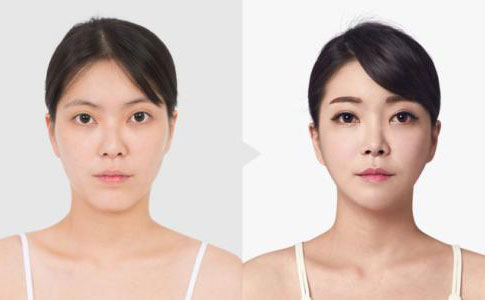 韓式埋線雙眼皮多久恢復自然？