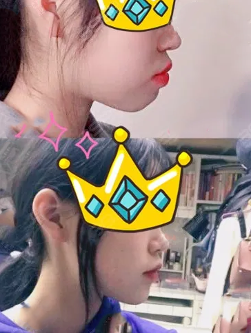 北京禾禾齒科牙齒矯正前后效果