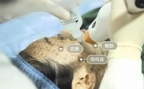 牙齒矯正期間是不能做熱瑪吉嗎？